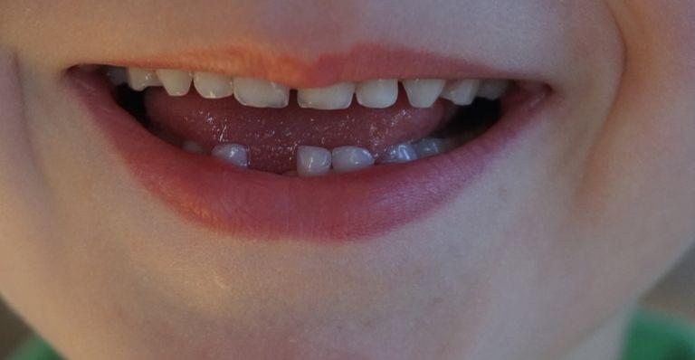 Por que os dentes de leite caem?